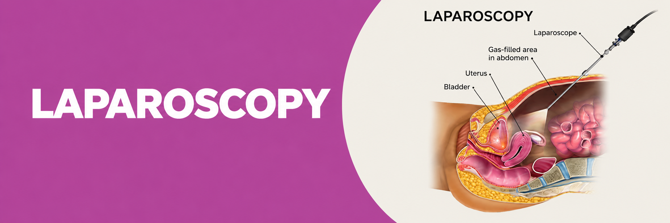 Laparoscopy